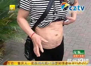 肚皮抽脂非但没瘦身,皮肤还成了火星表面!(视频)