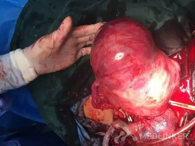 宫角妊娠孕足月胎盘植入疤痕子宫