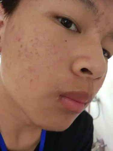 脸上的封闭性粉刺发炎了,以前没有做过处理,现在可以使用阿达帕凝胶吗