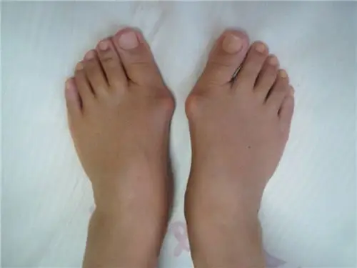 不同拇外翻手术方案疤痕图片_有来医生