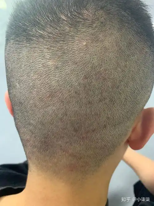 头皮上有很多红色连片的疙瘩 怎么办? - 知乎