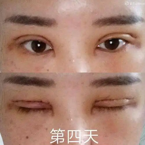做的双眼皮全切 恢复了大半年了