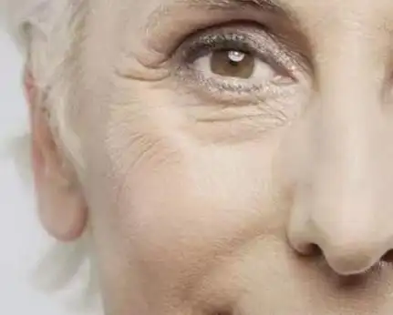 小马甲我想问问眼皮松弛怎么办?如何避免眼皮松弛的情况呢?