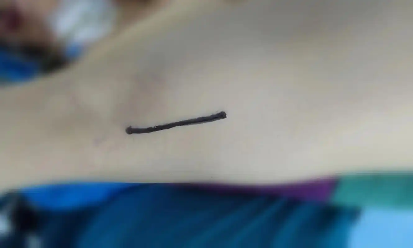 右腋下切口,非股动静脉插管, 成人先天性室间隔缺损修补术