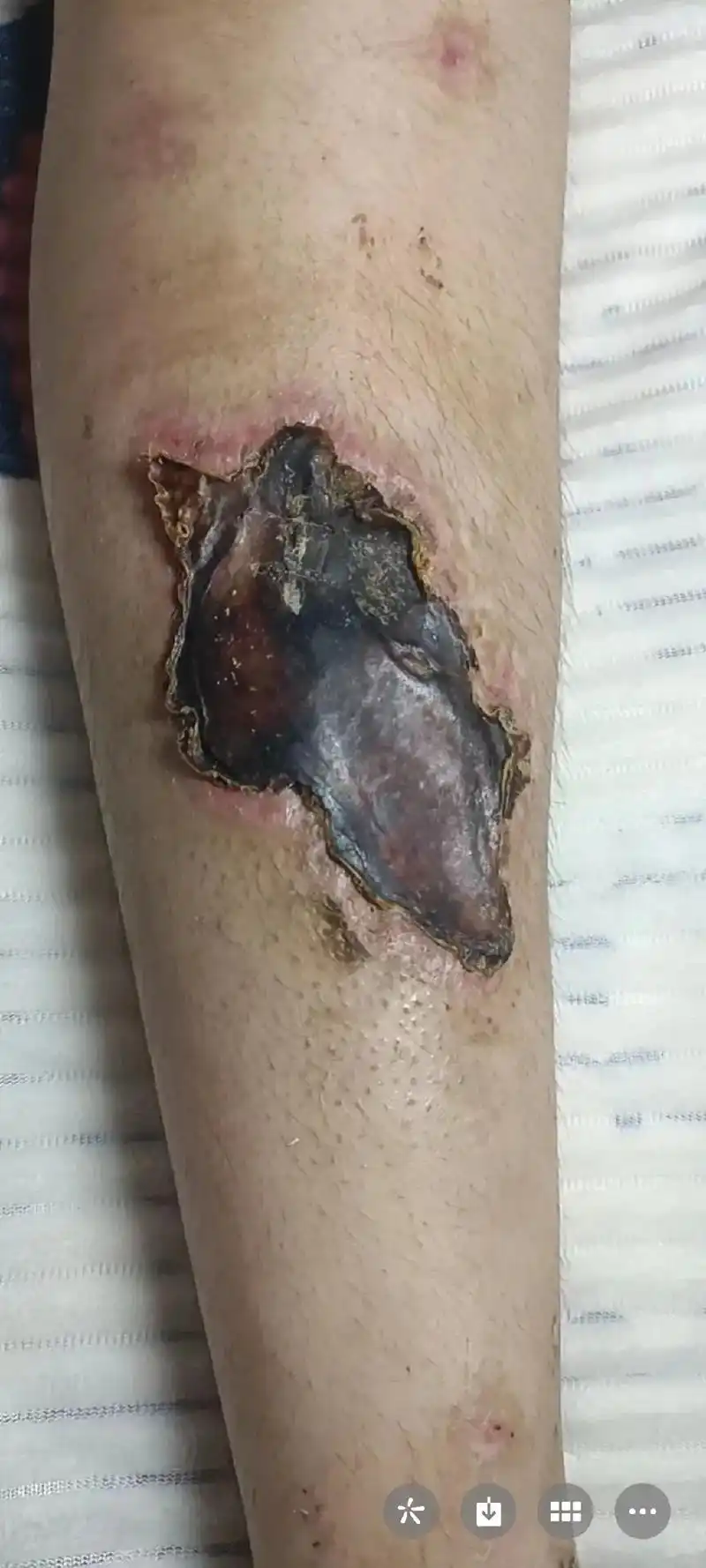 小腿双骨折后皮肤坏死未植皮换药愈合