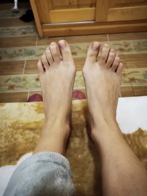 我这就是大脚趾外翻吧