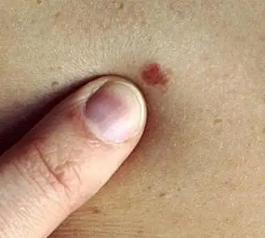 身体出现老年斑什么原因(背上长老年斑怎么回事) - 看百科