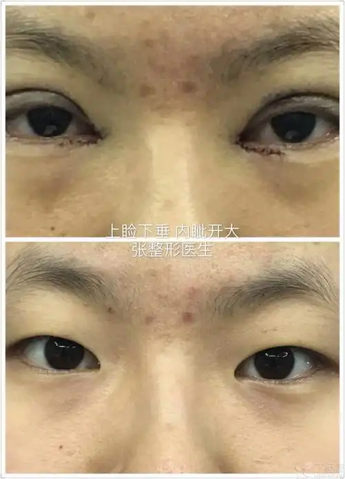【讨论】上睑下垂矫正术前后对比
