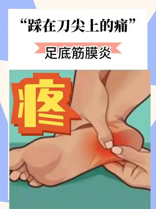 脚后跟疼痛别再不当回事了,可能是足底筋膜炎在惹事,要警惕!