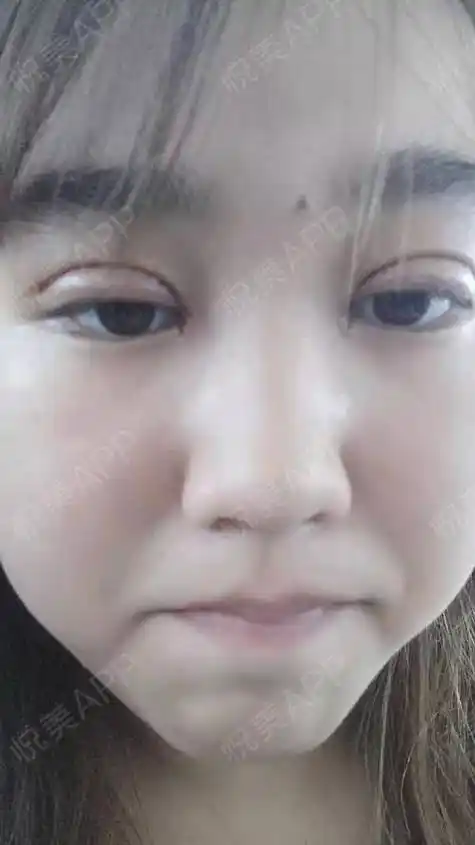 全切双眼皮术后3天_双眼皮术后3天_眼部整形术后3天_笑歌分享图片1