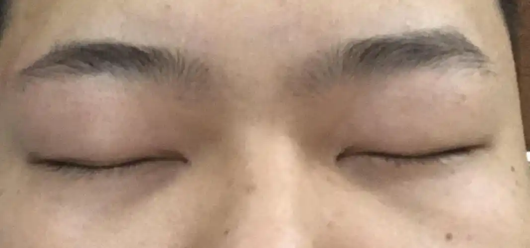 上眼睑下垂上眼睑肌无力肿泡眼