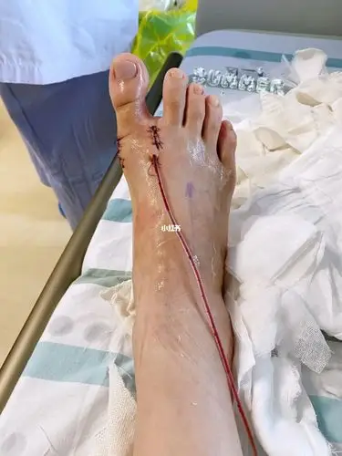右脚拇外翻微创术后第一天_引流_外套_医疗健康_医疗健康其他