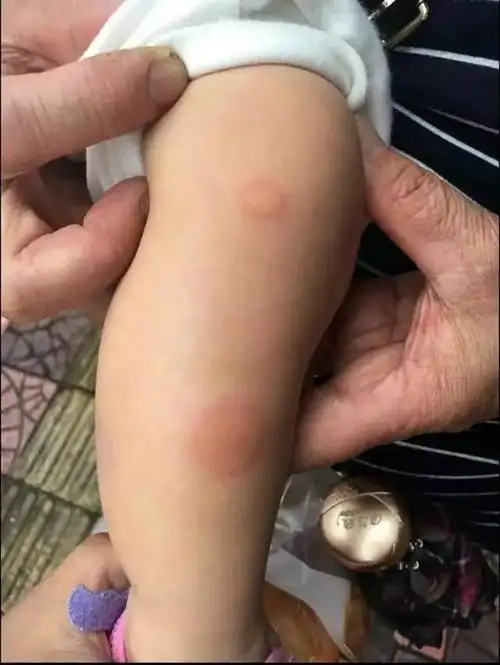 没想到螨虫这么"厉害", 我家宝宝被咬得遍体红疙瘩