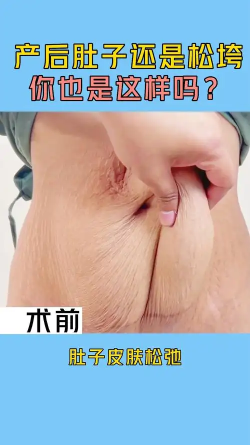 这位宝妈由于胎儿超过8斤,产后腹部皮肤严重松弛下垂!