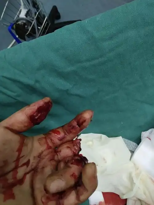 太和县人民医院骨一科又完成一一例复杂的手外伤的治疗