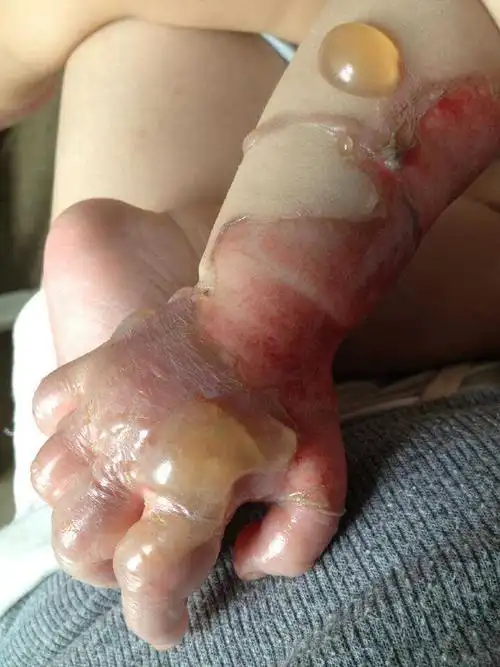 朋友家宝宝被开水烫伤了,各位宝妈一定要注意哦!