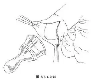 【包皮环切术】包皮环切术手术详细步骤,包皮环切术手术过程_百姓健康