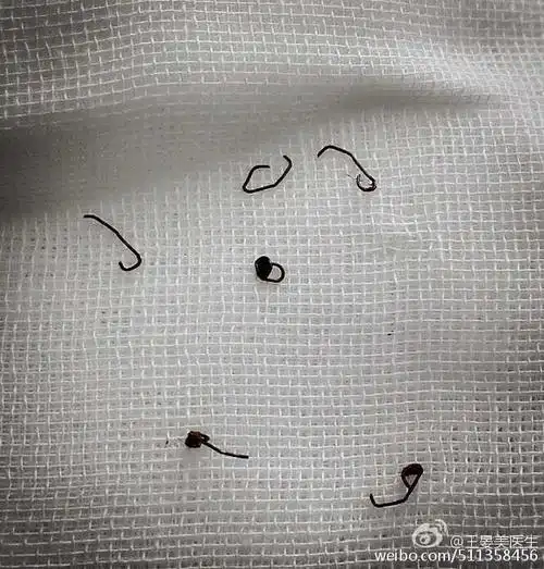 痔疮手术究竟是什么样的?