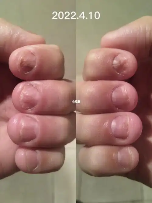 戒咬指甲第三周