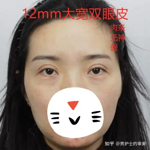 12mm宽平行双眼皮修复开扇形术后17天眼睛变化