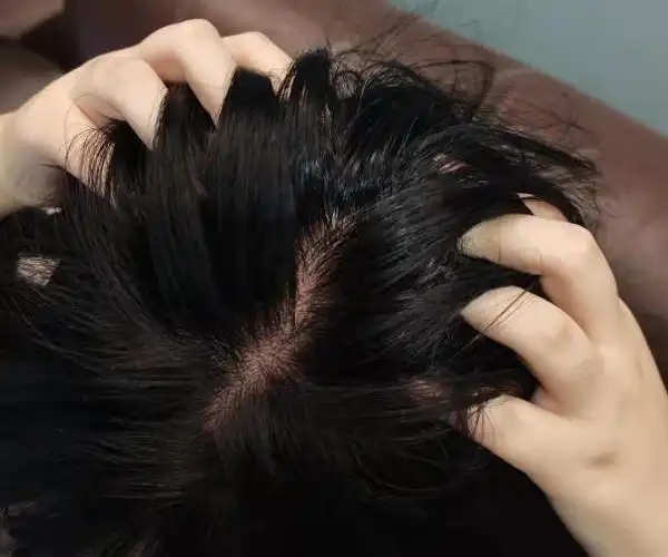 头皮痒是什么原因别错过康王酮康唑洗剂