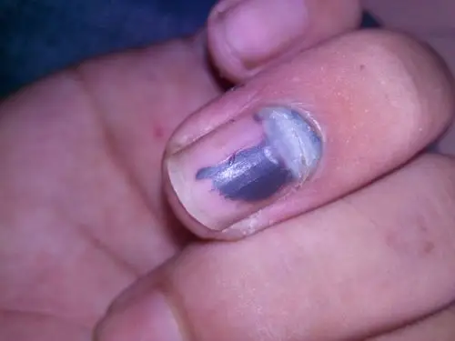 前两天从指甲根部看到了白色,而今天发现指甲根部的那一圈肉脱开了,不