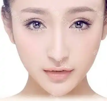 上海百达丽整形医生邵玉芳丨平行双眼皮和扇形双眼皮,哪个最好看?