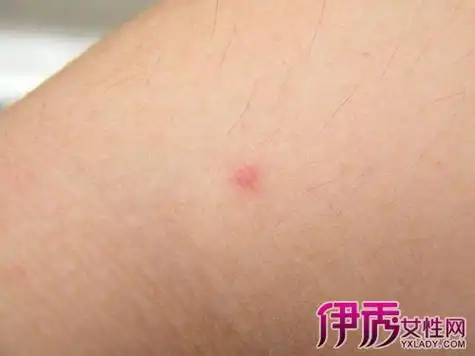 女性性病的早期症状都有哪些?