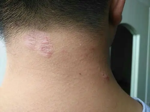 头颈部有这种事皮癣吗,怎么治?