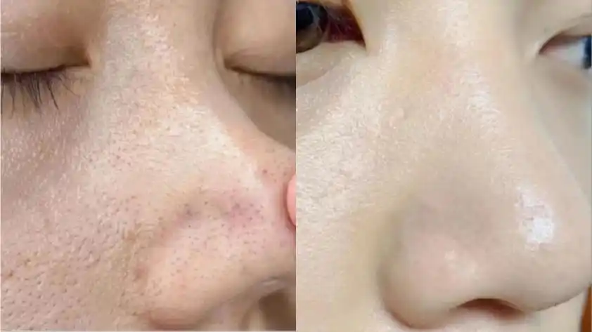 刷酸真能去黑头吗?