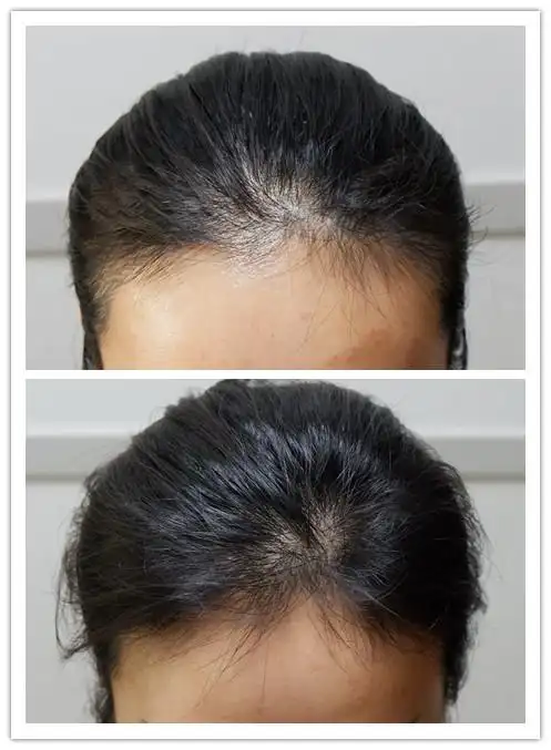 宝鸡mini生发发际线前后对比图-案例分享-28美容生发网