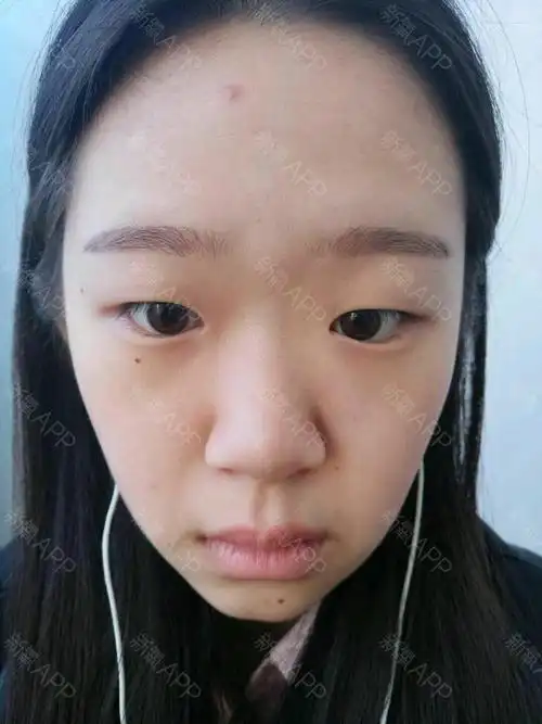 我眼角包太厉害了还是会有疤 会坚持擦药