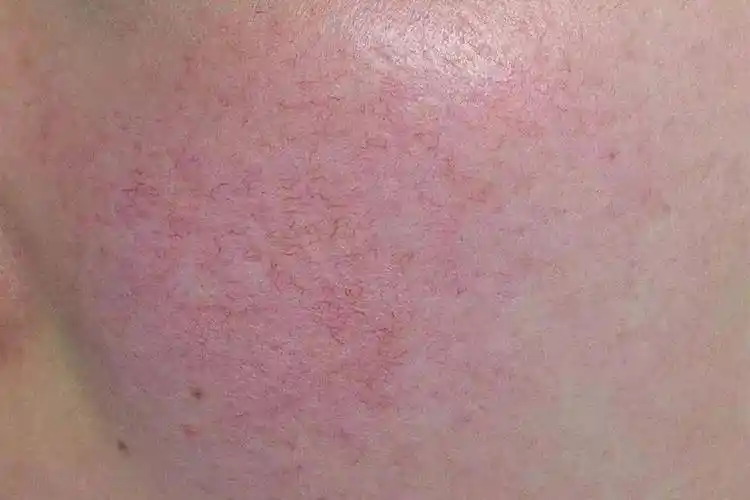 皮肤泛红,其实没那么简单..._血管_红色_修丽