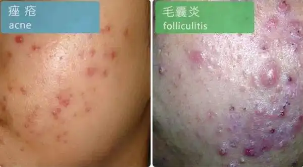 痤疮和毛囊炎有差异!切勿不要混淆