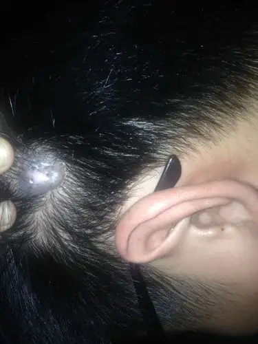 医生,您好,我从出生头上就有一个类似瘤的疙瘩,比起小的时候稍