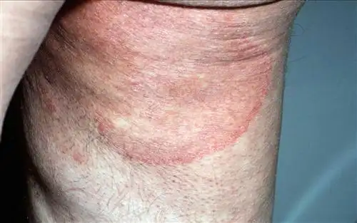 股癣是怎么回事