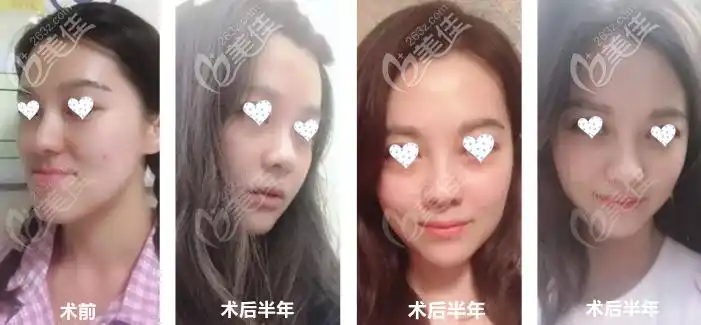 长脸地包天做正颌手术变短脸的真实经历,有图片有心得