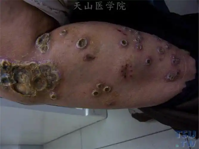脓疱疮:深脓疱疮(ecthyma)症状表现 - 皮肤病学 - 天山医学院