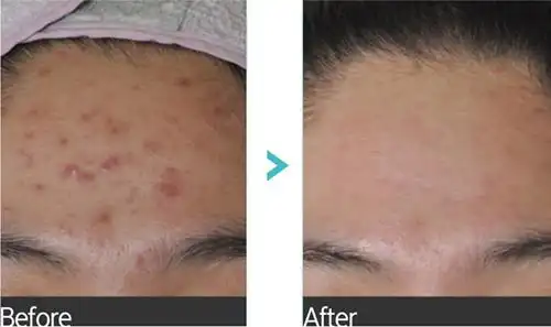 方案,请添加微信675762326进行详细设计价格:5000元起项目:祛痘印医院