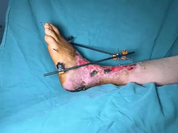 【临床聚集】惊魂瞬间—男子意外车祸左足离断,经开普仁外科争分夺秒