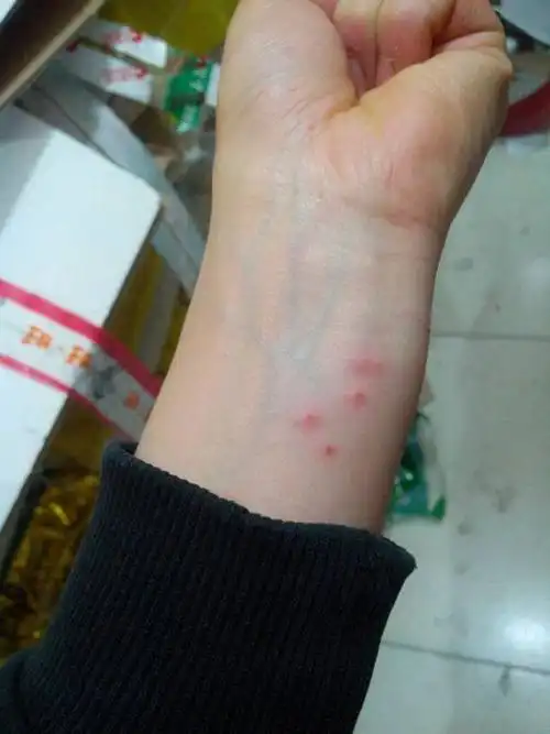 怎么判断床上有跳蚤卵(跳蚤咬的红疙瘩图片)_金纳莱网