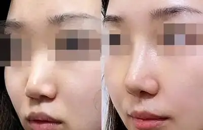 求美者原本山根部位略低于眉心,鼻尖向下,感觉鼻子基础还算不错,但是