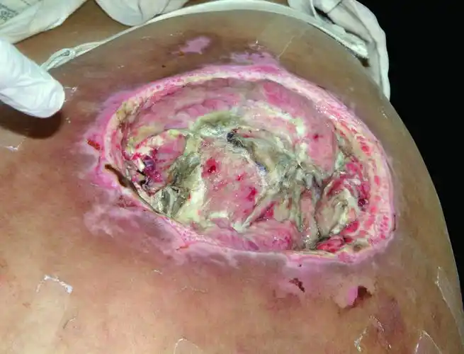 褥疮图片 褥疮症状图 褥疮病例图 皮肤性病科图谱物理性皮肤病 褥疮