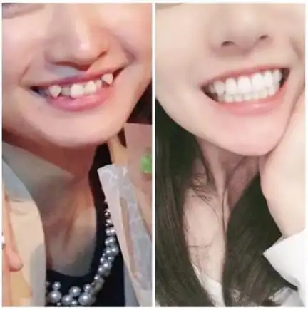 虎牙是怎么长歪的?