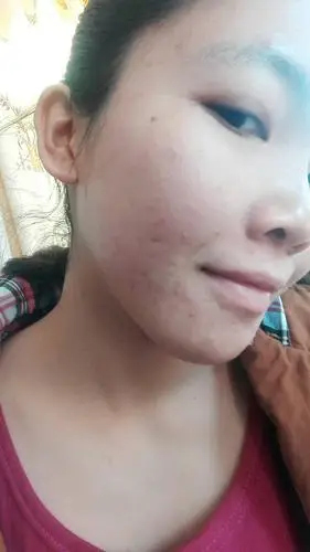 弟妹脸上毛孔粗大,好严重,有时候我弟都不敢看,怎么办呢?帮帮忙吧