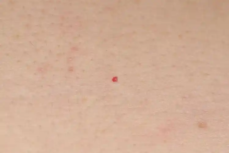 身上突然长了很多小红点,这是怎么了?