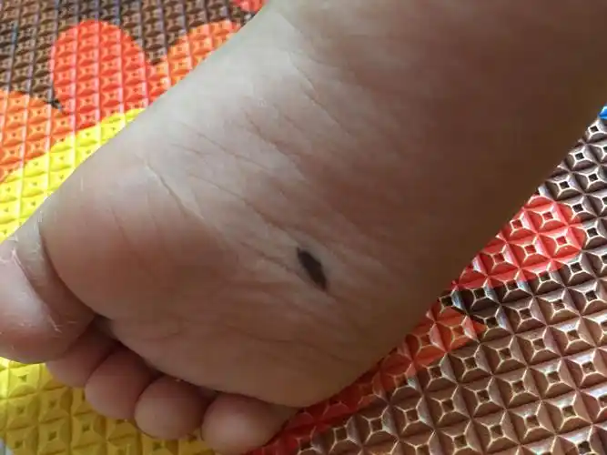 婴儿脚底痣
