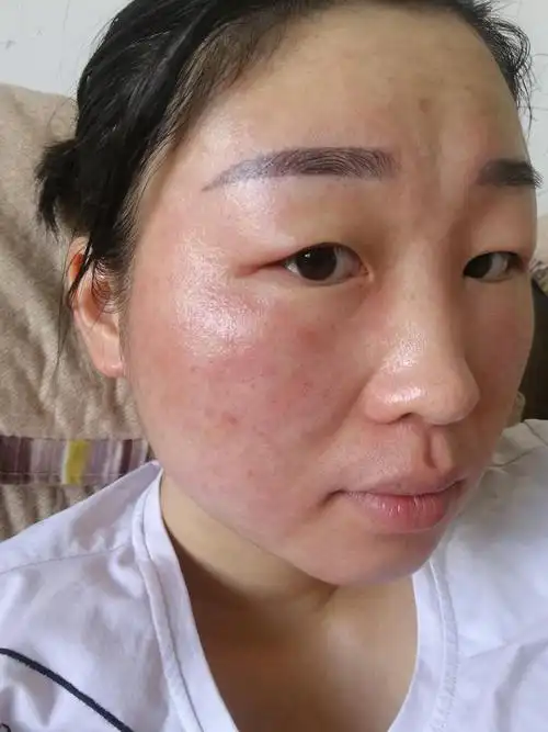 皮肤过敏了和激素脸喝中药能好吗