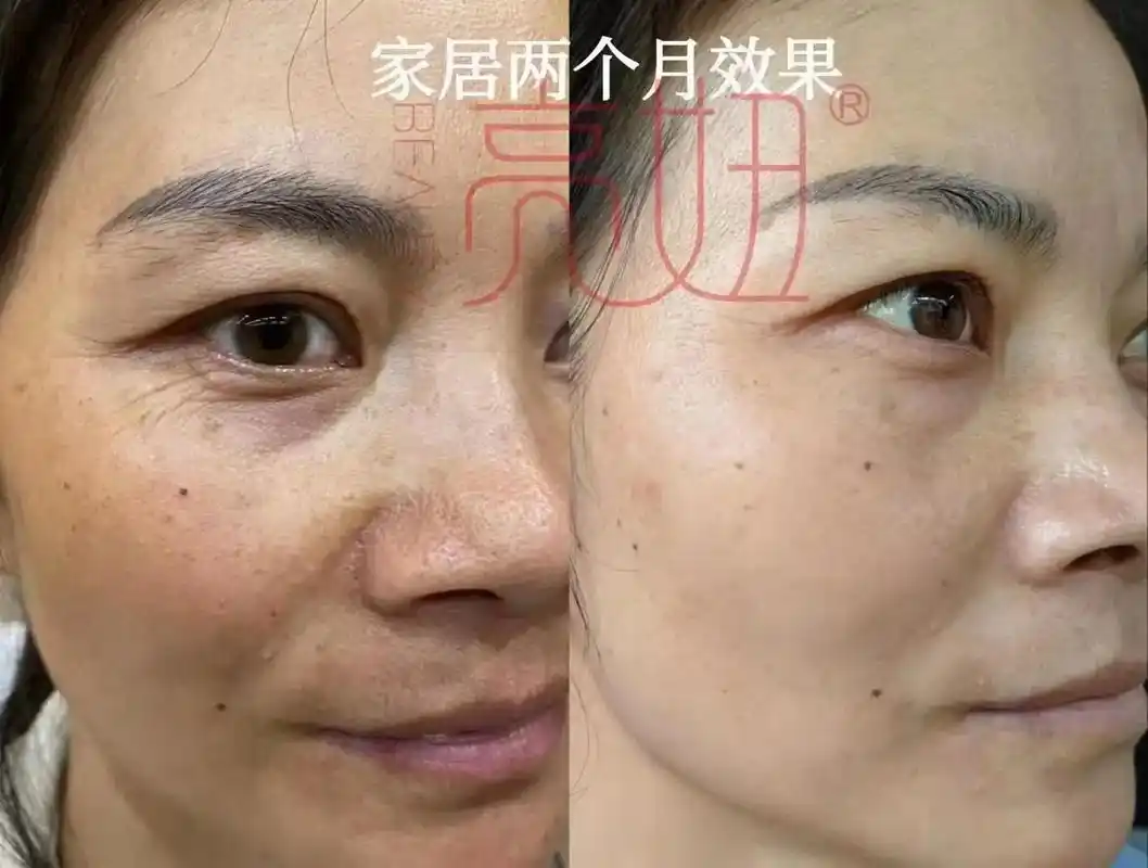 亮妞生物肽护肤品.夏季皮肤问题:油腻,不清爽 亮妞收敛膜清污 - 抖音