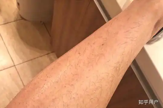 女生的小腿腿毛能彻底拔完吗